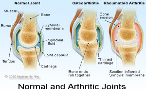 acupuncture for arthritic pain